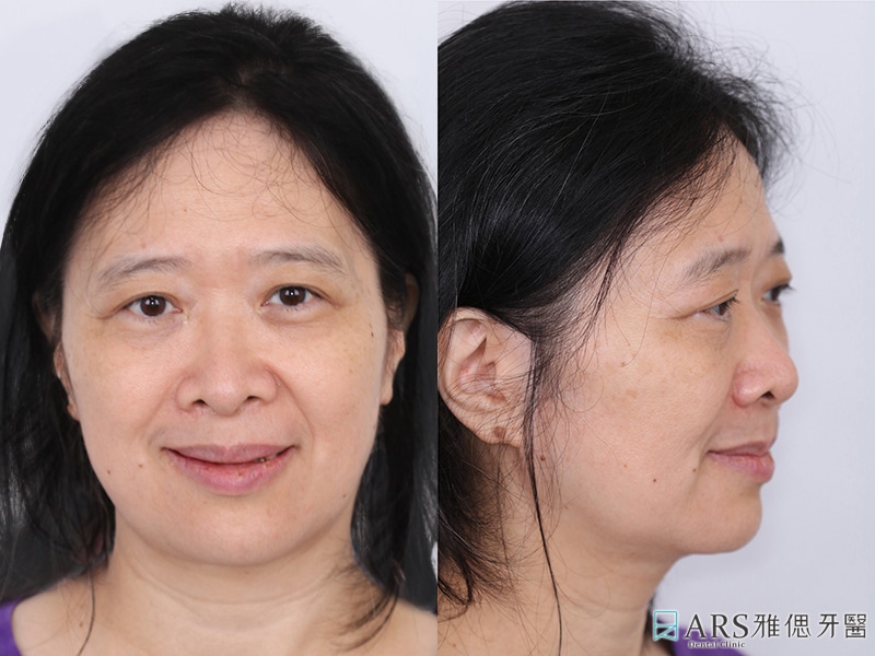 All-on-4-全口重建-治療前臉型外觀