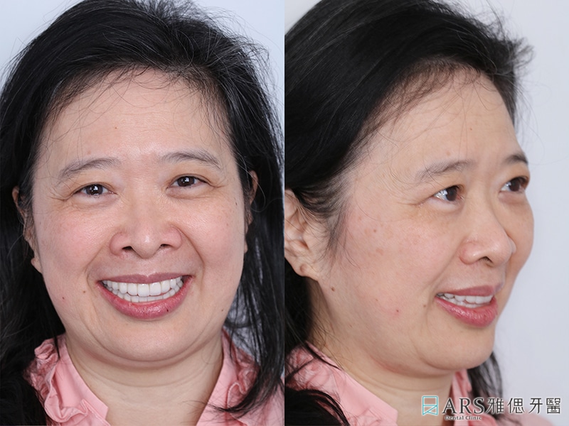 All-on-4-全口重建-治療後臉型外觀