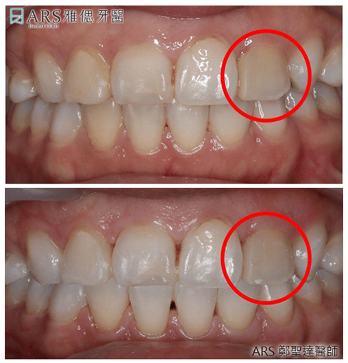 冷光美白療程前後對比，無法美白根管治療後變色的牙齒