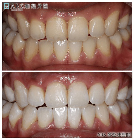 冷光美白療程前後對比，可去除色素沈積導致的牙齒黃