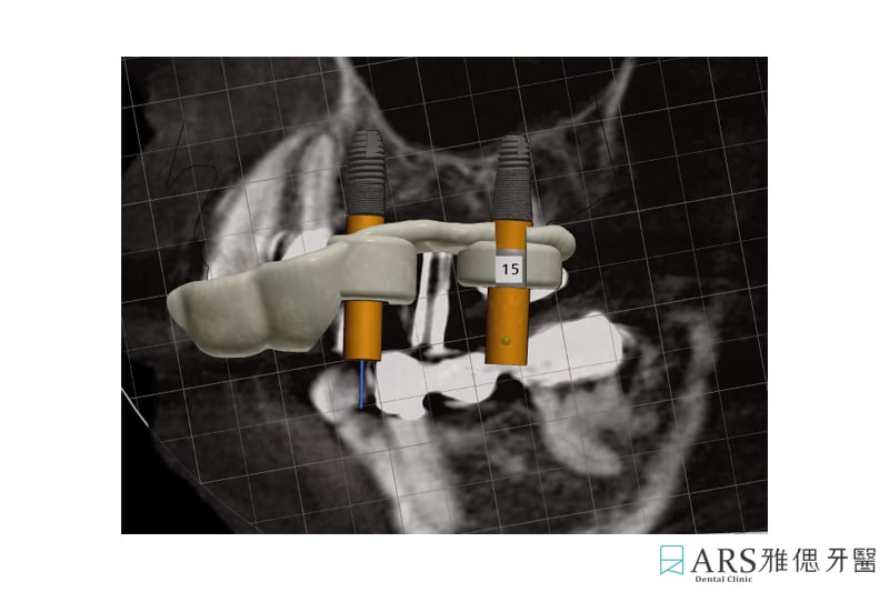 植牙手術-數位設計導引板