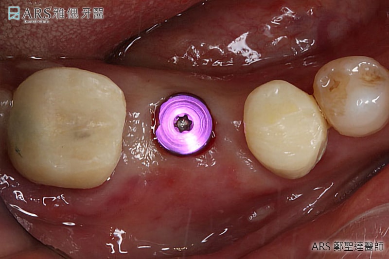 在植體上接入牙齦成形帽進行牙齦塑形
