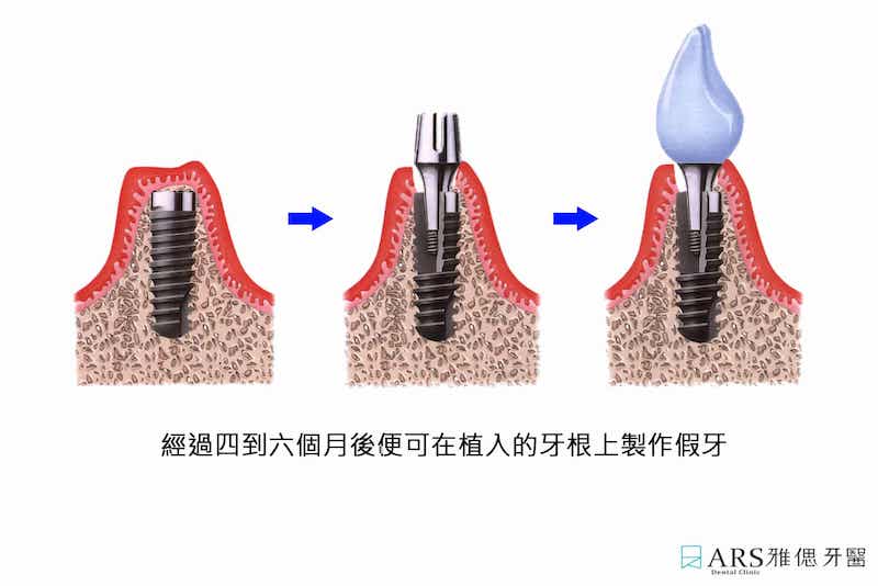 植牙步驟示意圖，植入植體約4~6個月後便可裝上假牙