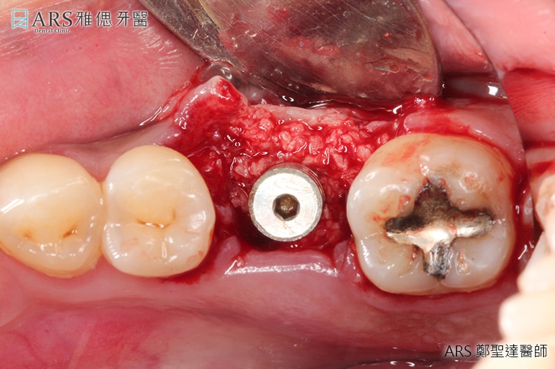 植牙補骨手術中照片
