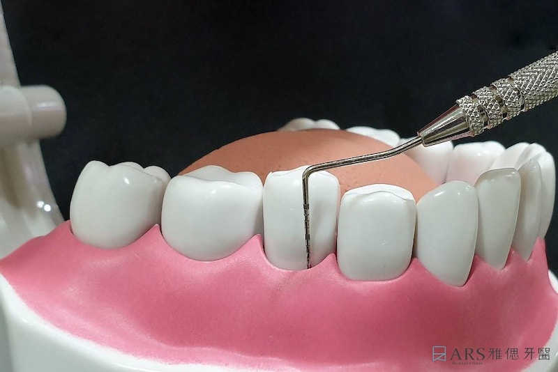 使用牙周探針進行牙周病治療示意圖