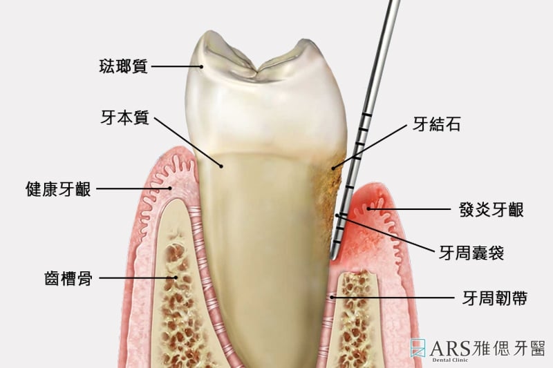 健康與牙周病牙齒結構示意圖