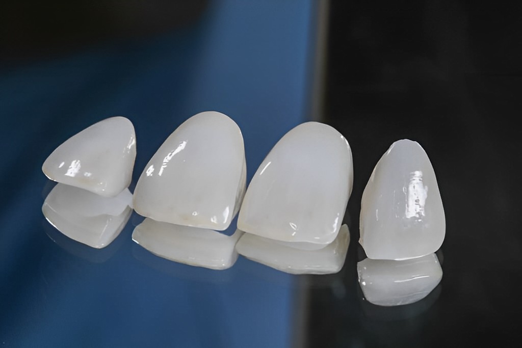 陶瓷貼片-瓷牙貼片-台北牙醫推薦-雅偲牙醫