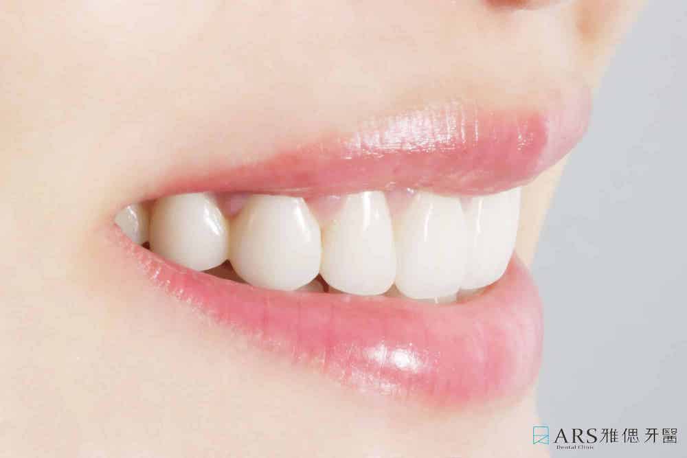 陶瓷貼片-瓷牙貼片-美白貼片-全瓷冠-45度微笑曲線牙齒