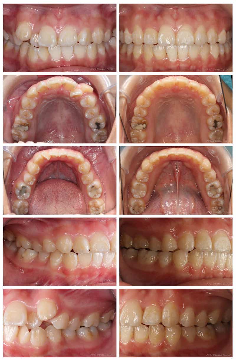 隱適美-隱形矯正-矯正前後牙齒排列變化