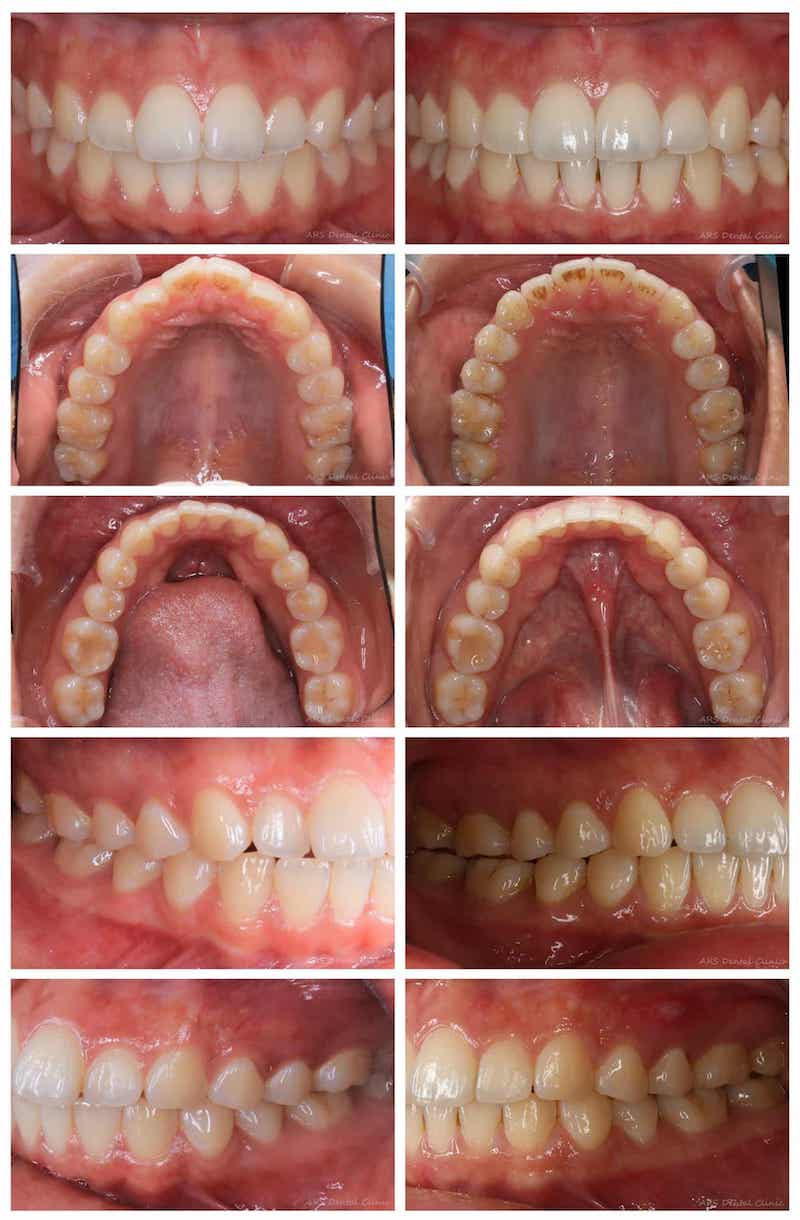 隱適美-隱形矯正-矯正前後牙齒排列變化