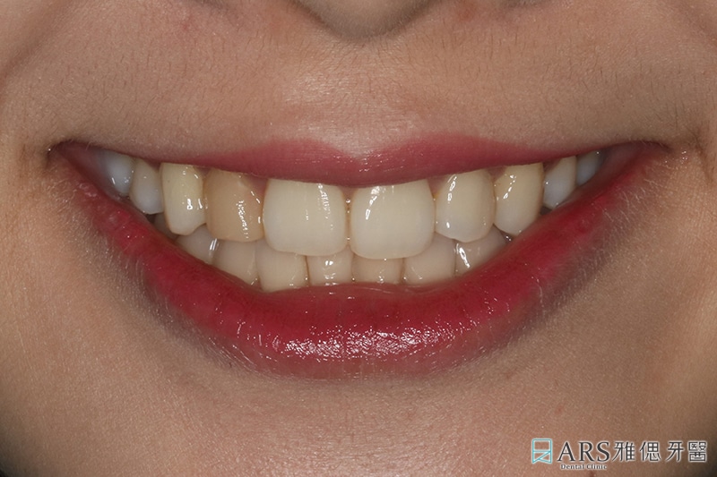 陶瓷貼片療程前口內照，有牙齒黃、牙齒顏色不均等問題