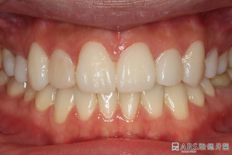 陶瓷貼片療程前口內照，有牙齒黃、牙齒顏色不均等問題