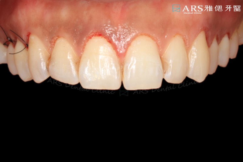 牙冠增長術術後，修整牙齦高度改善對稱性，拉長牙齒視覺比例