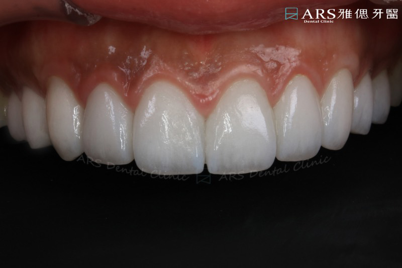 陶瓷貼片療程後上排牙齒近照，改善牙齒黃、提升對稱性，貝殼狀牙齒外型勾勒出完美微笑曲線