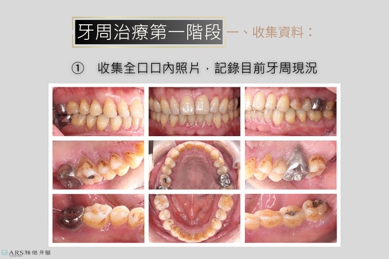 牙周病治療：收集口內照片
