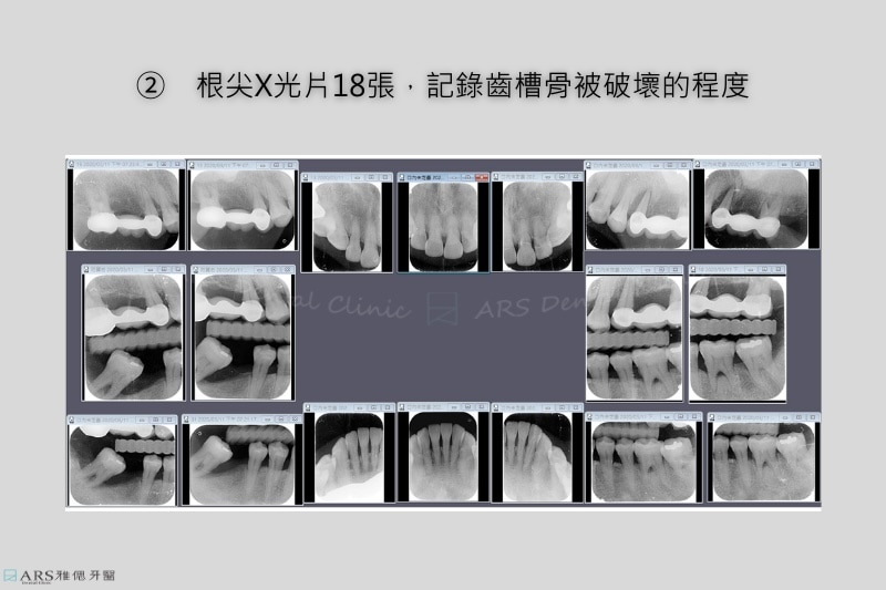 牙周病治療：根尖X光片18張