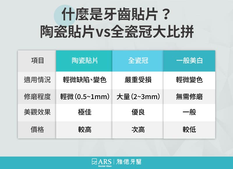 牙齒貼片全攻略：流程、優缺點及效果_1