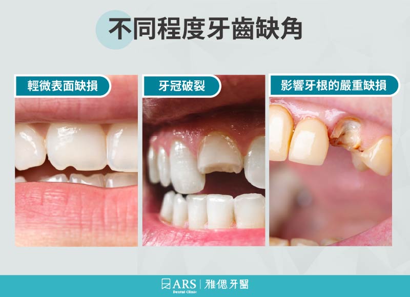 牙齒突然掉一角怎麼辦？緊急處理與修復方法_1